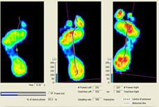 Computerized Pressure Platform Assessment