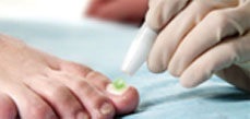 Fungal Nail (Onychomycosis)