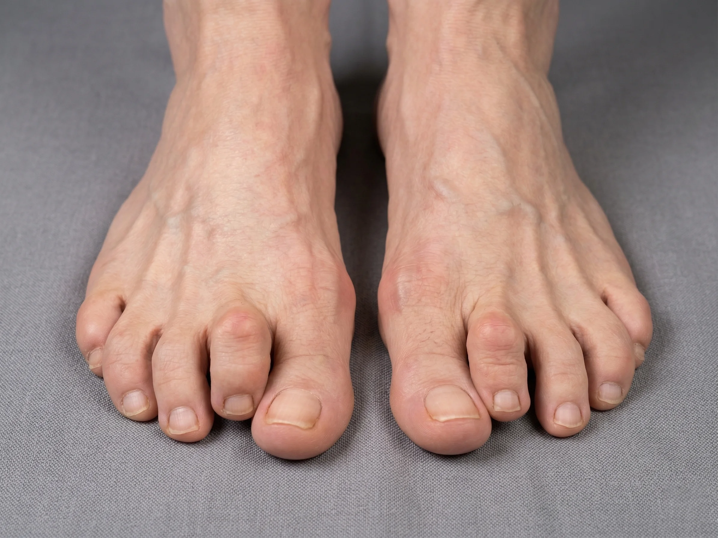 Hammer Toes