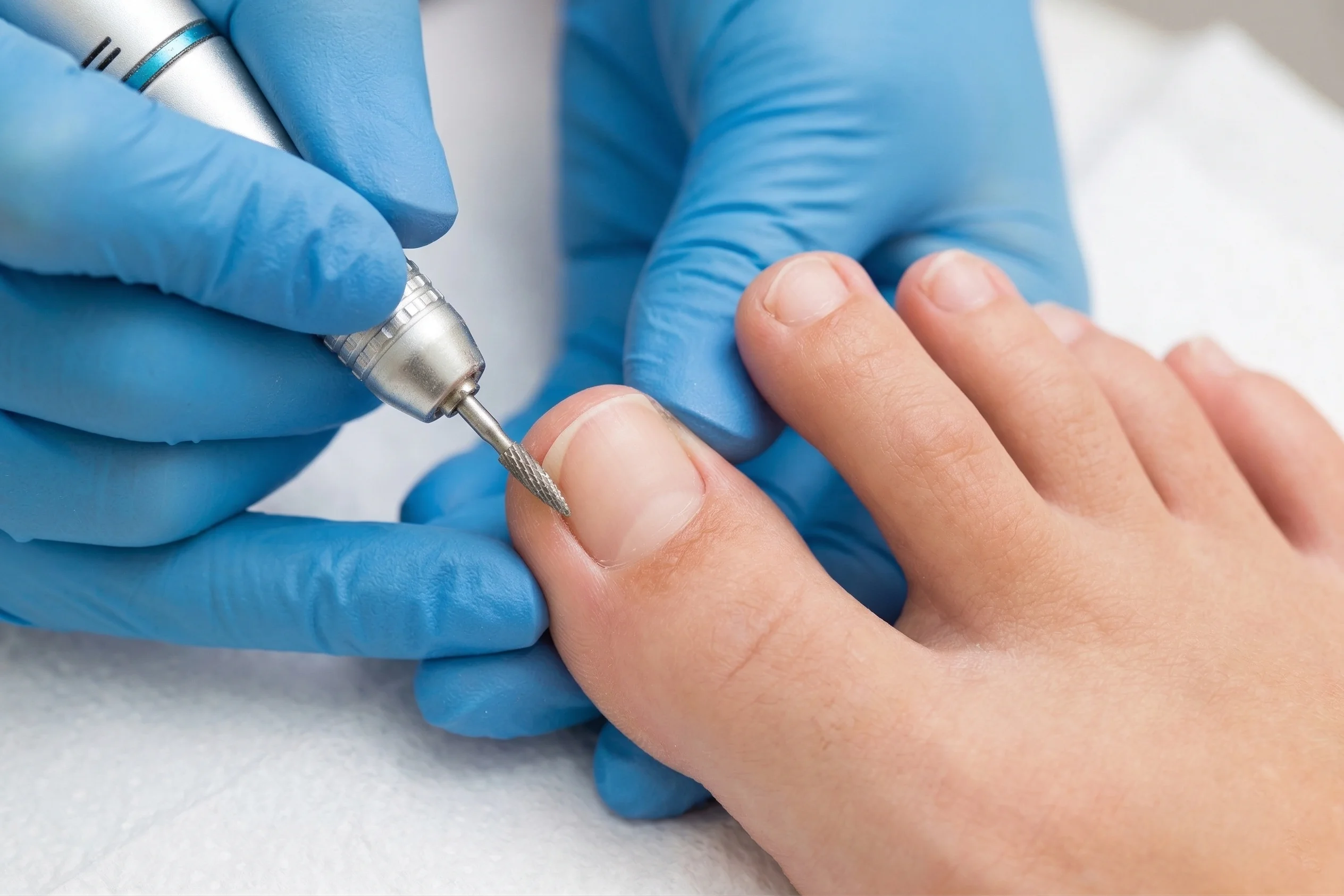 Nail Surgery