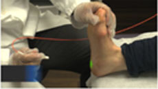 Plantar Fasciitis